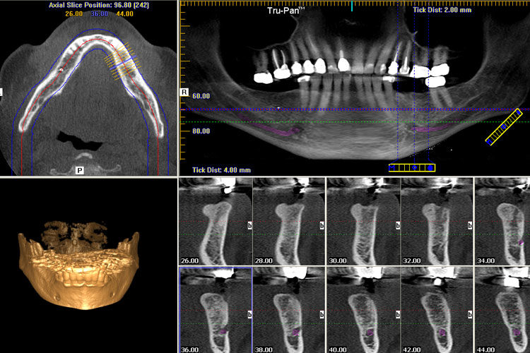 cone-beam-ct-scans-for-dental-implants-orland-park-il